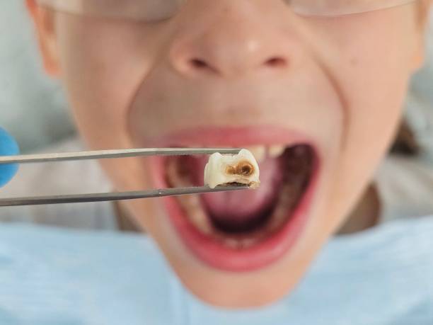 Best Walk-In Emergency Dentist in Lake Brownwood, TX
